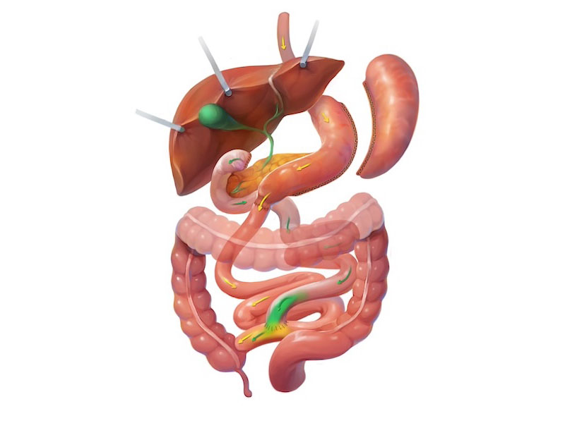 >Duodenal switch