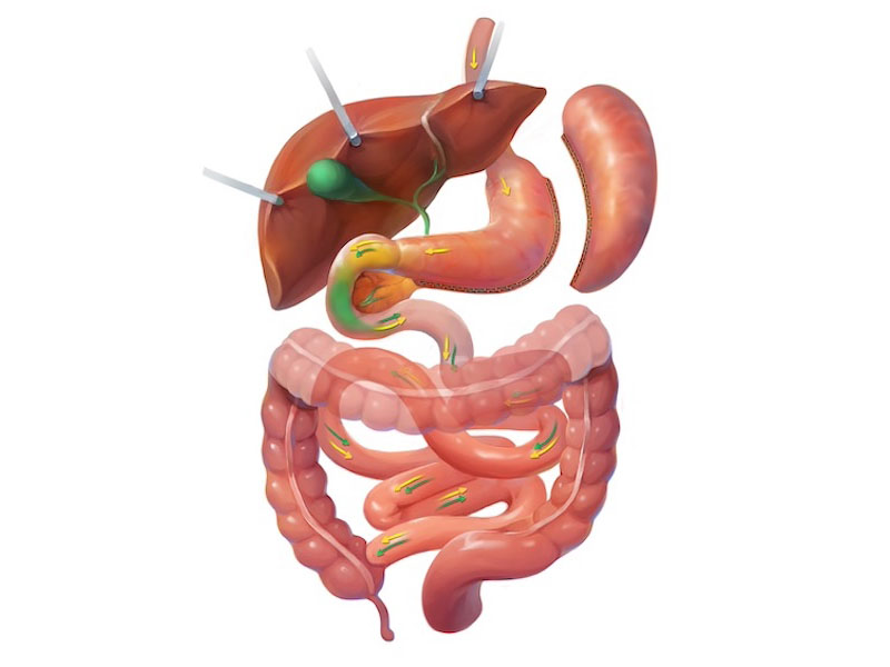 >Gastric Sleeve