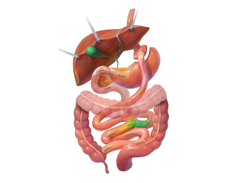 >Gastric Bypass